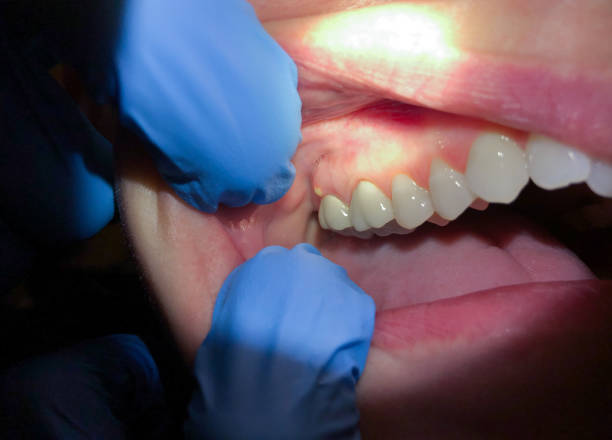 Best Emergency Treatment for Oral Infections in Dunean, SC